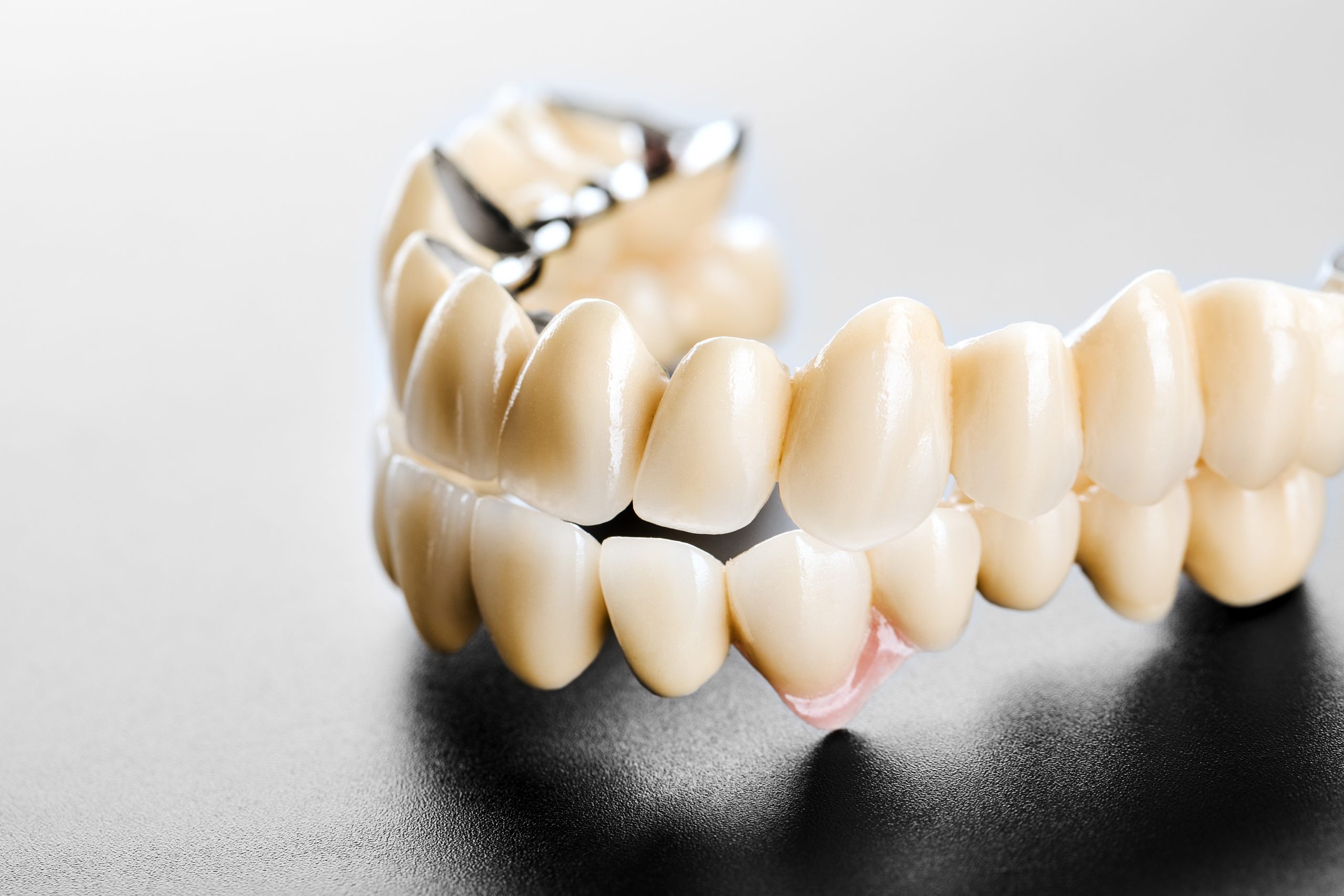 PFM - Porcelain Fused to Metal