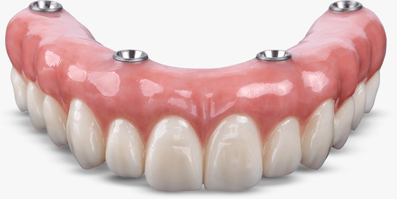 BruxZir Implant Prosthesis