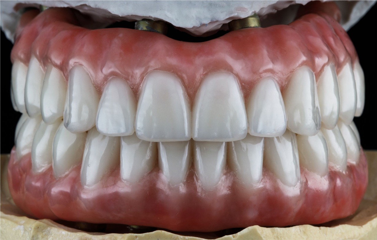 Screw-Retained Hybrid Denture