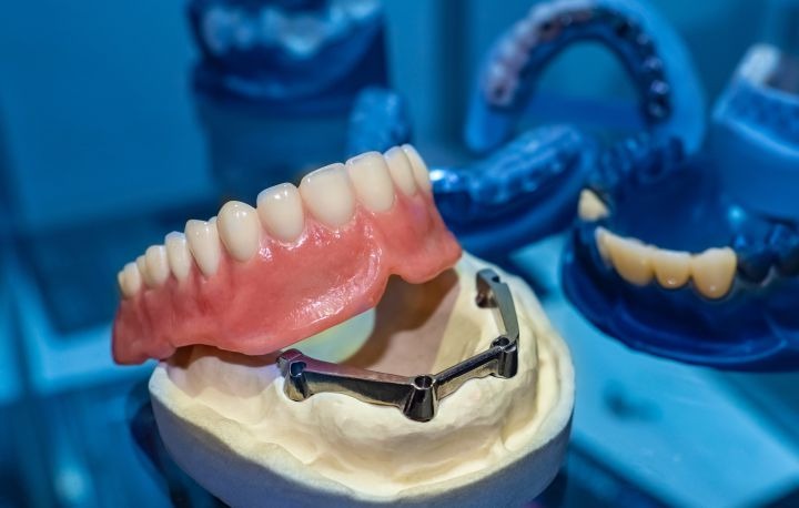 Implant Overdentures