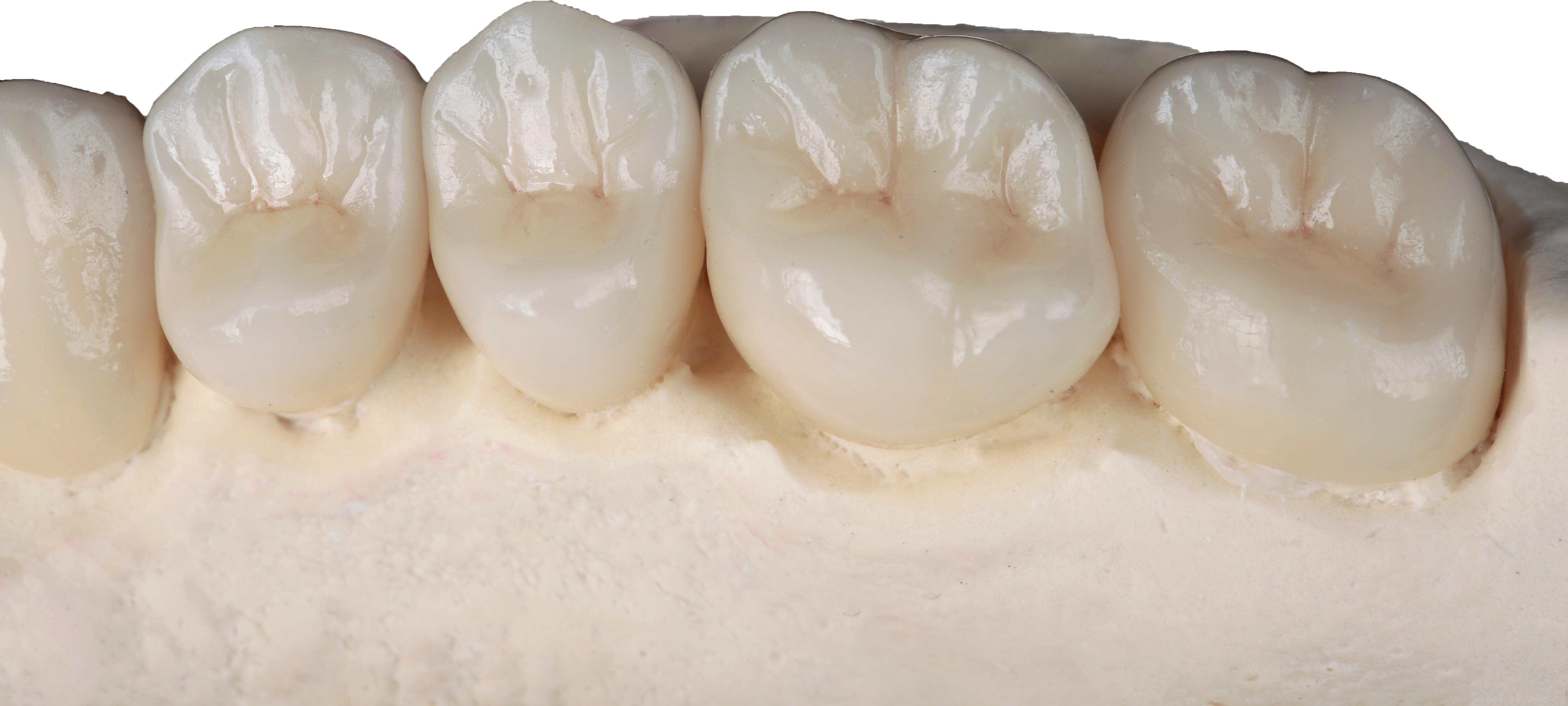 SoReal Premium Zirconia